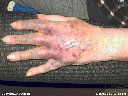 dads Hand - Happened due to a fall he took on July 22.