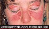 Butterfly flare up on face - This is lupus and yes I've had this happen to me numerous times.