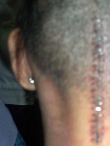 Staples - my undercut head after my brain surgery in 2005
