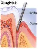 gingivitis - I have a friend who has gingivitis.