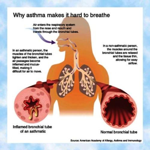 why asthma makes it hard to breath - the picture shows why asthma makes it hard to breathe. when you have asthma your airways are sensitive and inflamed. the bronchial tubes constricts narrowing the passageway for air thus making it harder for you to breathe. the linings of the airway inflames due to allergic reaction. the outcome of this is swelling and production of sticky mucus or phlegm.