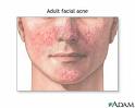Acne - Is stress related to acne