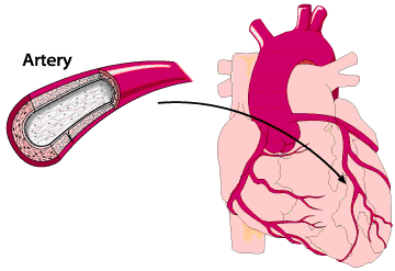 heart attack - this is what happen during heart attack when it is caused by blockage of the blood vessels. heart attack - this is what happen during heart attack when it is caused by blockage of the blood vessels.