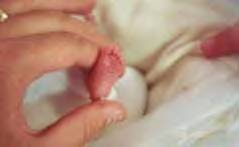 tiny foot - A true miracle baby. This picture shows how truelly small she was.