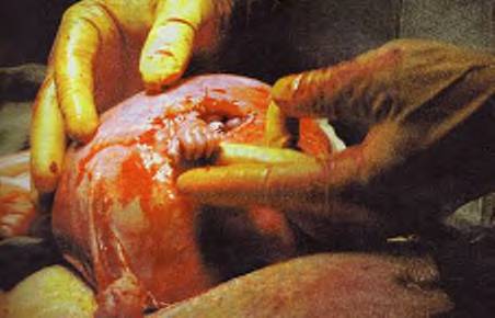 surgery on fetus - This is an amazing picture of an unborn fetus reaching out and grasping the doctors hand during a life saving surgery on him.