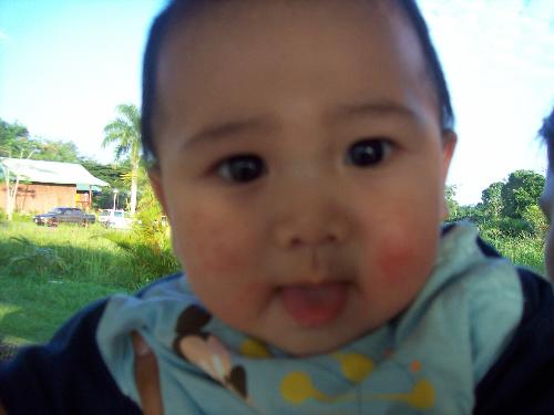 Got solution for the rash on my face? - This picture is taken since April 2008. But, until today the rash on my baby face is still on...