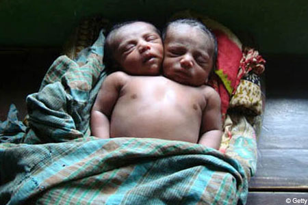 two-headed baby - A two-headed baby born in Bangladesh yesterday.