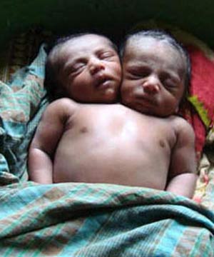 Kiron - [b]PASSED ON:[/b] Baby Kiron, born with two heads, seen here sleeping. He died a few days after being born in Bangladesh because his parents couldn't afford medical care.