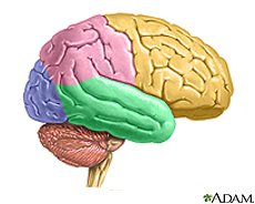 PSP Brain - Brain of Progressive Supranuclear Palsy