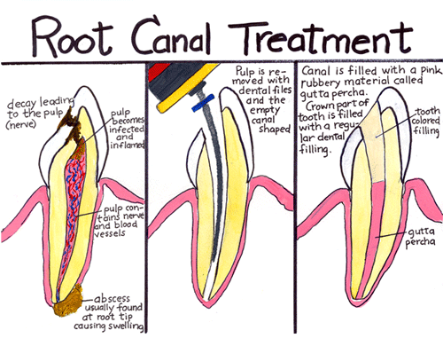 Root Canal - Procedure of root canal treatment