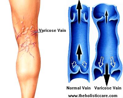Varicose Veins - A diseases of Veins specially in the legs