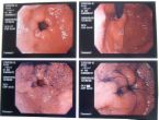 ulcer  - ulcer pic