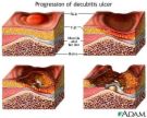 ulcer  - ulcer pic