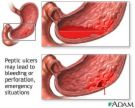 ulcer  - ulcer pic