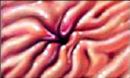 ulcer  - ulcer pic