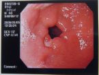 ulcer  - ulcer pic