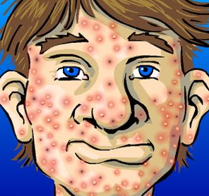 acne - face with acne