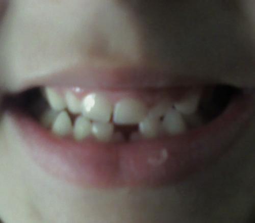 first tooth gone - Maverick looses first tooth