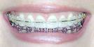 braces - A great investment!