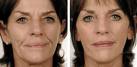 Before and After - Wrinkles reducing treatment
