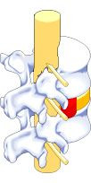 prolapsed disc - Prolapsed disc is most often seen in many people due to travel in a bummpy road