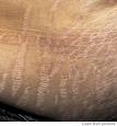 strecth marks - pregnancy stretch marks