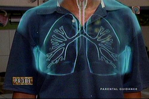 Lungs of Tb patient under treatment - This a picture of or xray or a representation of a patient of Tb being treated