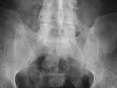 ankylosing spondylitis - ankylosing spondylitis is a form of rheumatoid arthiritis. It also affects the humans very worstly