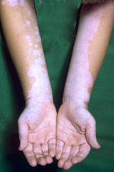 Vitiligo,Leukoderma - Vitiligo (also called 'leukoderma') is a common skin disease in which there is loss of pigment from areas of the skin resulting in irregular white spots or patches. The skin has normal texture. Vitiligo may appear at any age. Although it is a progressive condition, many people experience years or decades without developing new spots. Vitiligo is not contagious in any way. The precise cause of Vitiligo is not well-understood, though researchers are getting closer to knowing more. Many experts believe that vitiligo is the result of one or a combination of genetic, immunologic, biochemical and neurogenic factors. Susceptibility to vitiligo may be genetic. It is often, though not always, seen in families. It is thought by many experts that Vitiligo is an autoimmune related disorder, meaning a condition in which the body's immune system attacks on its own tissue or cells, in this case, the melanocytes (pigment cells which give the skin its color). This does not necessarily represent a weak or deficient immune system, but one which may be malfunctioning or misdirected. Other research has centered on vitamin deficiencies, and internal pathogens. Though the condition has no other known effects on the body, the psychological and social effects are well documented.  Vitiligo is more noticeable in darker skinned people because of the contrast, although when they tan, even lighter skinned people are affected. This condition affects about 1% to 2% of the world population. In some countries, the incidence is even higher. Worldwide, there are thought to be more than 100 million people with the condition. Vitiligo appears to be as old as the recorded history of man - it is mentioned in the Bible, and there are references to it in ancient Egyptian, Greek and Chinese writings. Today, vitiligo is a treatable condition, though treatment can take two years or longer to regain pigment, though repigmentation may not be 100%. There is more research being conducted than ever before; in Europe, in Asia, and in the U.S., new technologies and research are changing physicians' approaches to the condition. The recent mapping of the human genome has paved the way for advanced genetic research into vitiligo, and other cell-based theories are also gaining attention. Many experts believe that with genetic and biomedical technology improving as they are, that within the next few years, we will see a greater understanding of vitiligo, as well as faster and more reliable treatments for this, and other autoimmune conditions.