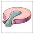 extrusion - the disc tears