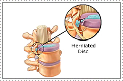 disc prolapse - This is an herniated disc