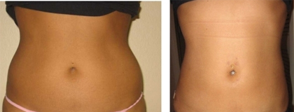 curves are FAT? - The before picture looks like a woman should look to me, but evidently, there are some who prefer to have NO curves at all.