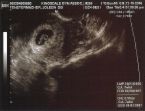 Becoming a mom - sonogram picture