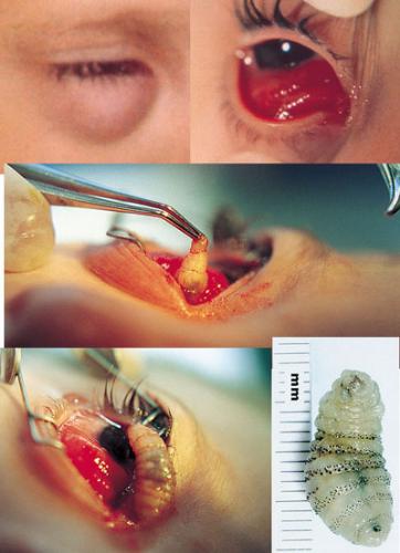 myiasis in eye - picture shown a maggot is pulled out form aorund eye area...this is example of myiasis