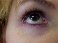 dark circles under eyes  - dark circles 