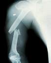 Broken Bone - A break in the arm