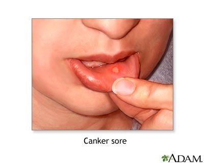 Mouth ulcer - Very painful