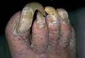 toe nail - sick