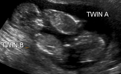 ultrasound picture  - picture of an ultrasound of identical twins