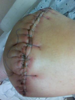 Three weeks post amputation - Three weeks after my BKA amputation. 28 staples and 30 sutures; it's almost completely healed now.