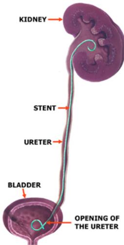Kidney Stint - opens up the kidneys