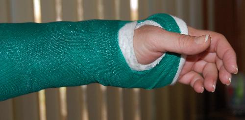 new cast - latest treatment for work-related injury