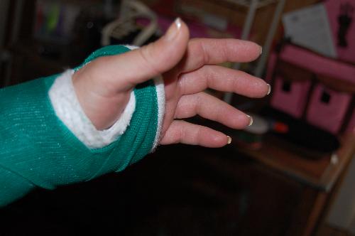small part of cast - cast from palm to above elbow