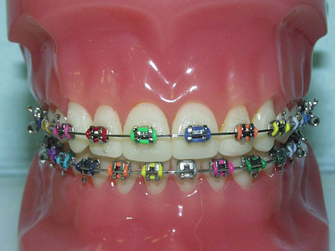 colorful braces - it's pretty nice to look at... but they say it's painful...