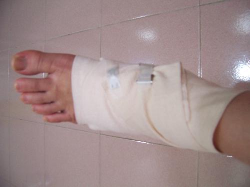 injured leg - my injured leg