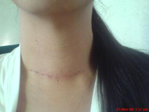 total thyroidectomy - I had my thyroid glands removed and that's the scar on my neck. total thyroidectomy - I had my thyroid glands removed and that's the scar on my neck.