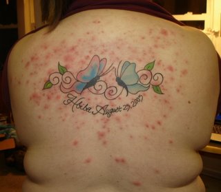 back acne - back acne is another problem
