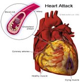 Human Heart - Human heart showing the vessale causing the heart attack