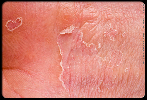 This looks like skinned skin, but it isn't. - I copied this from medicine net. It is eczema (spelling?). There are a couple of other pictures that it could be also, so please check them out.