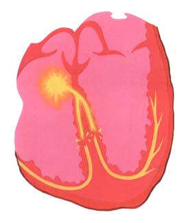 heart blockage - 274 x 324 - 23k - www.brighamandwomens.org/.../Images/pace2.jpg heart blockage - 274 x 324 - 23k - www.brighamandwomens.org/.../Images/pace2.jpg
